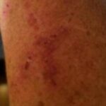 Lupus bruising