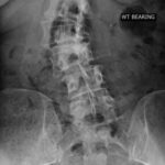 My lumbar spine scolosis