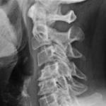 my cervical spine